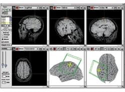 TMS techniques using Brainsight scanners use computer brain maps to target treatment precisely.