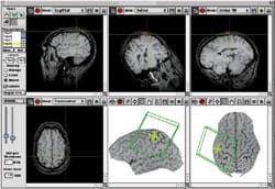 TMS techniques using Brainsight scanners use computer brain maps to target treatment precisely.